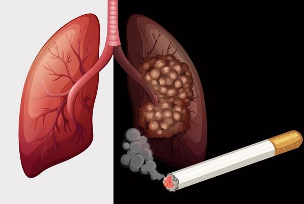 pluća pušača i zdrava pluća